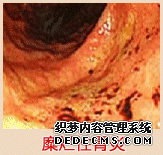 糜烂胃炎