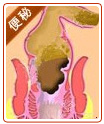 大便不易排出